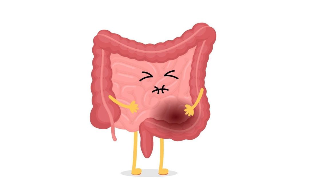 Syndrome de l’intestin irritable